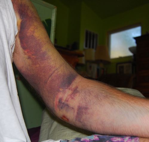 http://zhurnaly.com/images/bruised_arm_day_3.jpg