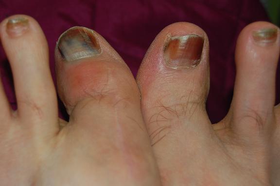 http://zhurnaly.com/images/running/Zombie_Toes.jpg
