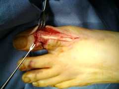 Torn toe tendon repair operation "after" - click to enlarg