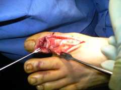 Torn toe tendon repair operation "before" - click to enlarge